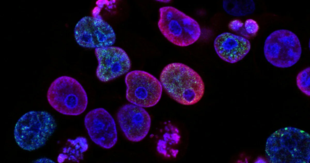 Merck and Moderna's Personalized mRNA Cancer Vaccine Succeeds in Phase 3 Trial