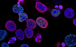 Merck and Moderna's Personalized mRNA Cancer Vaccine Succeeds in Phase 3 Trial