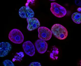 Merck and Moderna's Personalized mRNA Cancer Vaccine Succeeds in Phase 3 Trial